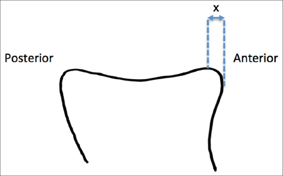Figure 1: Axial schematic representation of the glenoid showing the presence of bone anterior to the peak of the anterior glenoid rim. 