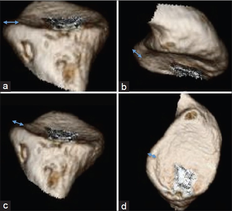Figure 2: Various views from 3D CT reconstruction of an uninjured glenoid showing the presence of bone beyond the peak of the anterior glenoid rim. (a) View from inferior to superior; (b and c) Views from superior to inferior; (d) en-face view of glenoid