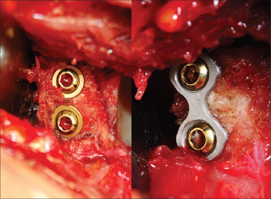 Figure 1: Final view of latarjet procedure using mini-plate fixation or using screws and washer