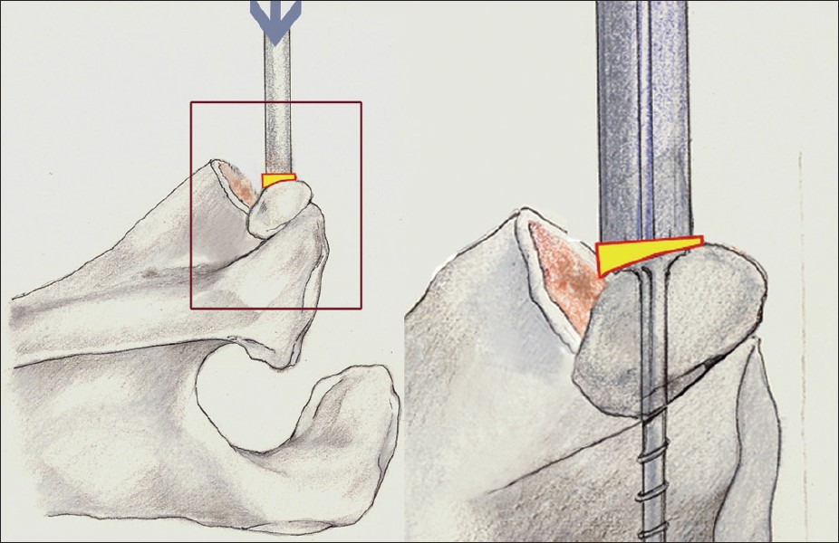 Figure 3: Bone match between the coracoid bone graft and the glenoid bone surface using mini-plate fixation