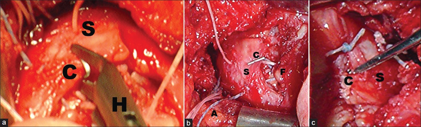 Figure 1: Intraoperative images show the technique of radio-opaque marking of the torn cuff tendon. (a) A special forceps are used to grasp the titanium clip during the procedure, (b) The position of the clip is shown prior to tying the medial and lateral row sutures, (c) The final position of the clip is shown after tying the sutures from the medial and lateral row anchors. (C: Clip, S: Supraspinatus, H: Grasping forceps, F: Rotator cuff footprint, A: Sutures from anchors)