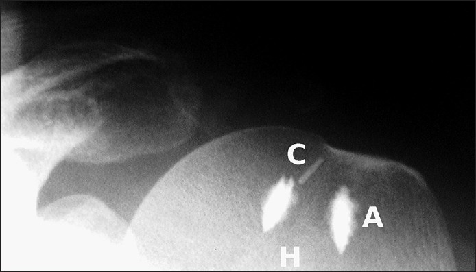 Figure 2: Immediate post-operative radiograph demonstrates the position of the metal marker (C) relative to the anchors (A) and humeral head (H)