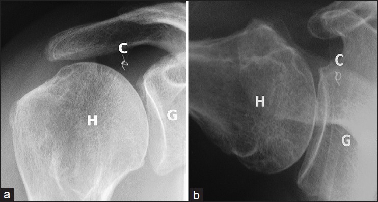 Figure 3: Anteroposterior (a) and axillary-lateral radiographs (b) show the medialized position of the metal marker (C), and are suggestive of failure of repair. (H: Humeral head, G: Glenoid)