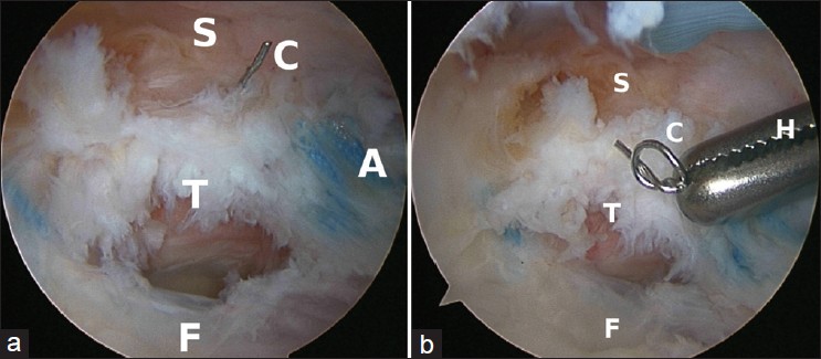Figure 4: (a) Arthroscopic evaluation of a failed cuff repair shows the torn tendon (T) of the supraspinatus (S), and the metal marker (C) is seen attached to the torn edge of the cuff. (F: Cuff footprint, A: Sutures from anchors), (b) Arthroscopic retrieval of the metal marker (C) is shown prior to final repair. (F: Cuff footprint, A: Sutures from anchors, S: Supraspinatus, T: Cuff tear)