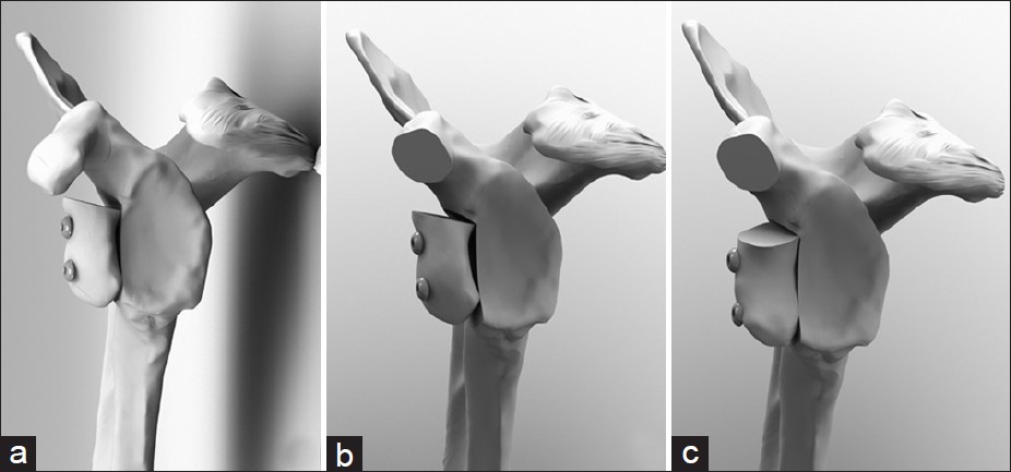 Figure 2: Coracoid reconstructions of a 30% anterior glenoid defect on a left specimen. (a) Allograft coracoid reconstruction, (b) Classic Latarjet coracoid transfer, (c) Congruent-Arc Latarjet coracoid transfer. Note that in each rendering, all soft tissues are omitted for clarity. Also, in the case of the allograft reconstruction the coracoacromial ligament is preserved