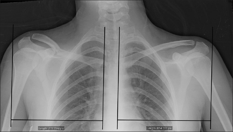 Figure 1: Comparison of the lateral offset of the gleno-humeral joint between involved (right) and healthy (left) side on a chest X-ray. Figures were calculated using a measuring tool and do not have a metric unit correlation