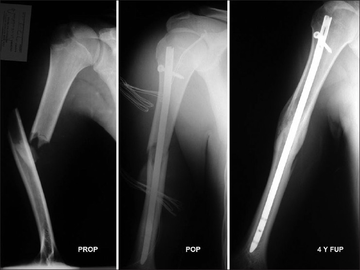 Figure 1: Preoperative and postoperative X-ray of a midshaft humeral fracture (OTA type 12-B2) in a 17-year-old patient involved in a traffic accident. Four years postoperatively, there was solid callus formation
and the constant score was 100 (excellent)