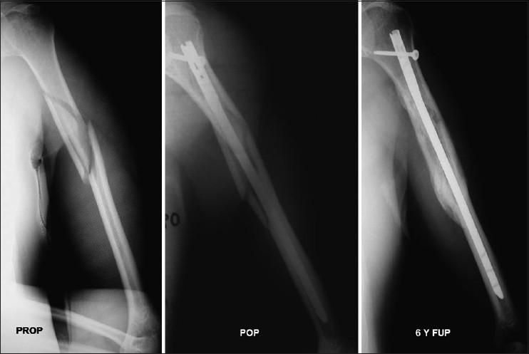 Figure 2: Preoperative and postoperative X-ray of a humeral shaft fracture extended to proximal third of the diaphysis (OTA type 12-B1) in a 60-year-old patient after a fall of his height. Despite the extended comminution, the nail was impacted at the distal part and led to uneventful healing of the fracture. The constant score at 6 years postoperatively was 95