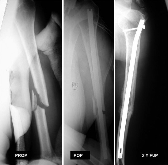 Figure 3: Preoperative and postoperative X-ray of a humeral shaft fracture extended to distal third of the diaphysis (OTA type 12-B2) in a 23-year-old patient after a fall from height. Despite the 1 cm diastasis at the fracture site, healing was achieved as soon as 3 months postoperative. The 2-year follow-up showed solid callus and a constant score of 94