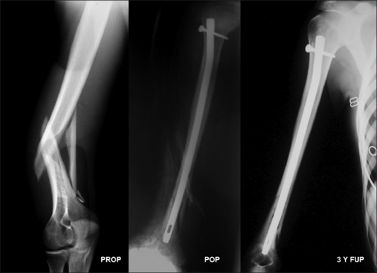 Figure 4: Preoperative and postoperative X‑ray of a humeral shaft fracture extended to the distal third of the diaphysis (OTA type 12‑B1) in a 22‑year‑old patient involved in a traffic accident. Excellent radiological result was seen 3 years postoperatively. The constant score was 95 at the last follow‑up