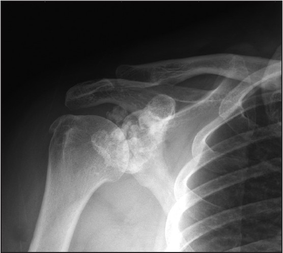 Figure 1: Anteroposterior radiographs shows multiple round and ring like calcifications at glenohumeral joint