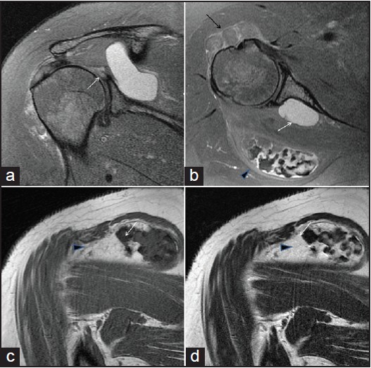 Figure 2: Oblique coronal (a) and axial (b) fat suppressed proton density, oblique coronal T1-weighted (c) and T2-weighted magnetic resonance images (d). (a) There is T2 high signal intensity (short arrow) at posterosuperior labrum, suggesting labral tear. (b) Large T2 high signal intensity cystic lesion (white arrow) is seen adjacent to the labral tear extending into spinoglenoid notch, suggesting paralabral ganglion cyst. A fatty mass is seen between anterolateal cortex of the humeral head and anterior belly of the deltoid muscle, indicating intramuscular lipoma (black arrow). Another encapsulated mass is also seen in intermuscular space between infraspinatus and deltoid muscles (arrow head). (c and d) Arrow heads in c and d indicates encapsulated mass as seen b. It had abundant villous projections on the medial portion. It also had multiple rings like or round low signal intensities on all pulse sequences with background low signal intensity on T1-weighted image and high signal intensity on T2-weighted image. This represents calcification arising from chondroid matrix (white arrow)