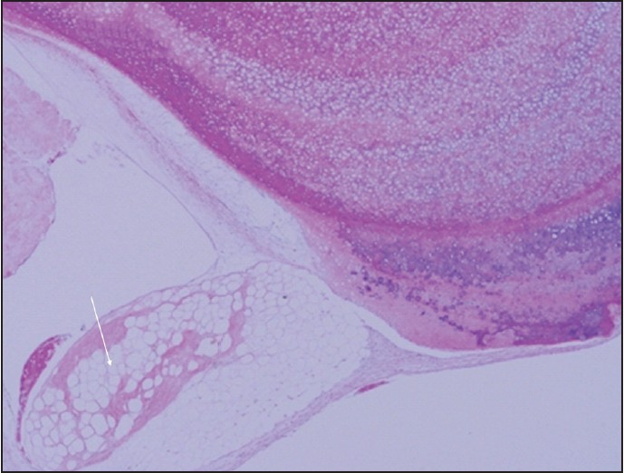 Figure 4: Microscopic examination confirms focal osteochondral metaplasia of villous fat tissue in lipoma arborescens (H and E, ×40)