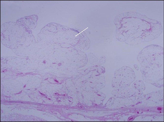 Figure 5: Histologic examination reveals hypertrophic nodular villous proliferation with adipocytes in subsynovial connective tissue, consistent with lipoma arborescens (H and E, ×12.5)