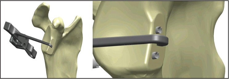 Figure 2: The drill guide is placed with the tip over the bony defect and the arm flush along the face of the glenoid