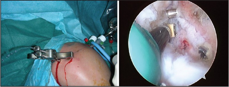 Figure 3: The drill guide with the two pins are placed under arthroscopic control: The drill sleeves and the central drill bit are advanced until they protrude 4 mm medial to the cortical margin of anterior glenoid