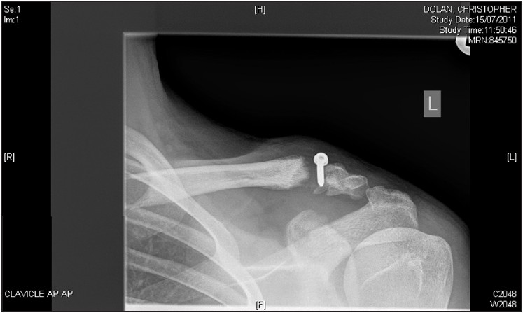 Figure 1: X-ray at 2 months after initial operation demonstrating osteolysis at the fracture site