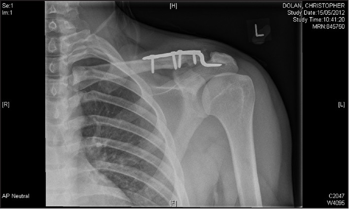 Figure 2: Final radiological result after screw removal and hook plate fixation