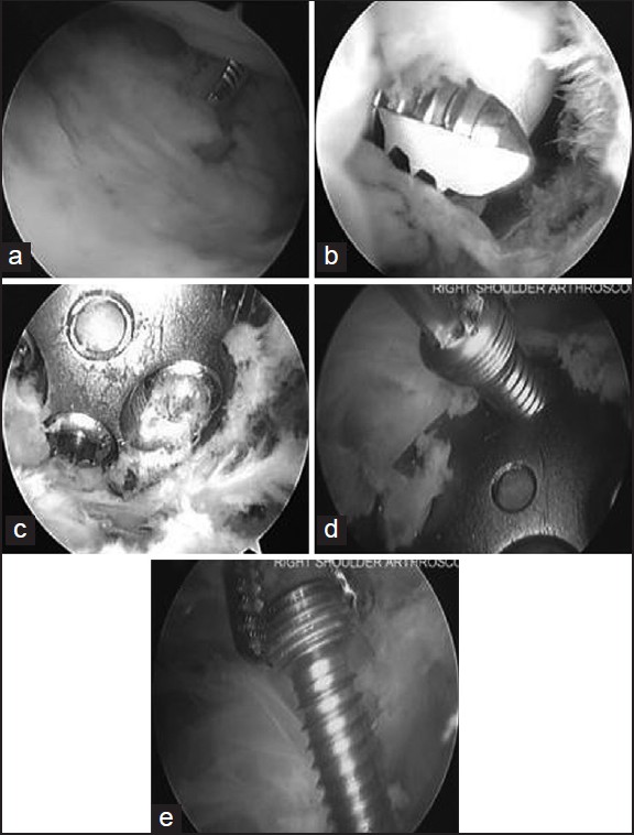 Figure 1: Right shoulder arthroscopic images obtained from a posterior portal using a 30° arthroscope and performed in the lateral decubitis position, in a patient undergoing screw removal. Diagnostic glenohumeral arthroscopy reveals the prominent screw (a) and associated glenoid erosion (b). Through subacromial bursoscopy, the plate is exposed after excision of scar tissue with a combination of a radiofrequency device, a shaver and a labral elevator (c). The screw to be removed is identified (d) and grasped with a needle holder as it is withdrawn (e)