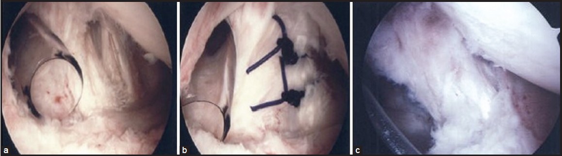 Figure 6: Second-look arthroscopic views from the posterior portal of a patient with a Type II Conrad tear of the right shoulder. (a) Posterior view during initial arthroscopy showing a degenerative split tear in the tendon consistent with a Type II tear. (b) View at initial arthroscopy following repair of the Type II tear with two polydioxanone sutures. (c) View of a healed Type II Conrad tear at second-look arthroscopy