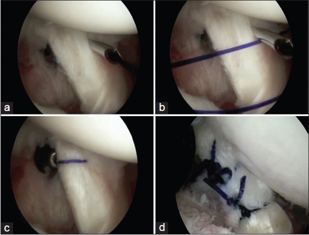 Figure 1: (a) While viewing from the posterior portal in a right shoulder, a crescent-shaped suture passer was introduced through the anterior midglenoid (AMG) portal and passed through both sides of the split tear of the subscapularis tendon. (b) Polydioxanone suture is passed into the joint, and the suture passer is removed. (c) The free end of the suture is retrieved out the AMG portal and tied. (d) A view of a different patient, showing placement of two sutures for repair of a more extensive subscapularis tear