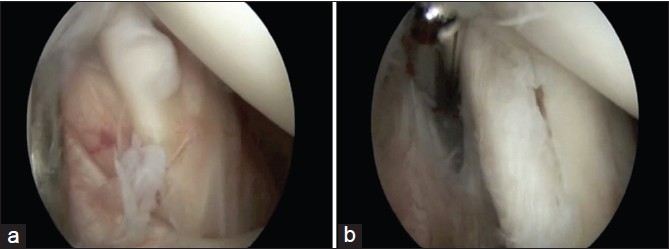 Figure 2: (a) Arthroscopic view from the posterior portal of a Type I Conrad lesion in a right shoulder. Note the nodule (the so-called Conrad lesion) on the leading edge of the tendon. (b) Following debridement of the nodule, a longitudinal split tear is seen