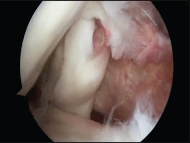 Figure 3: Arthroscopic view from the posterior portal of a Type II Conrad lesion in a left shoulder. There is a visible split tear on the leading edge of the tendon and the remnant of a Type I Conrad lesion more medially