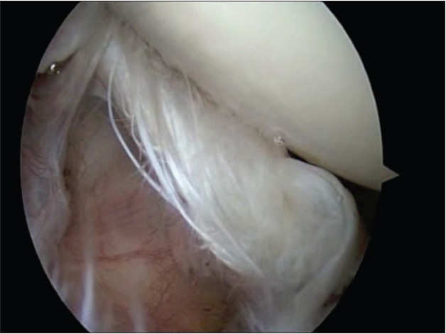 Figure 4: Arthroscopic view from the posterior portal of a Type III Conrad lesion in a right shoulder. There is extensive fraying and degeneration of the leading edge of the tendon