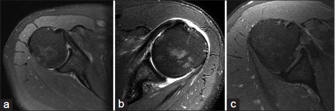 Figure 5: Axial magnetic resonance images of three patients with non-insertional longitudinal split tears of the subscapularis. (a) Image from a patient with a Type I tear. Note intact subscapularis footprint and minimal tendinopathy. (b) Image from a patient with a Type II tear. Note the intact subscapularis footprint and mild tendinopathy. (c) Image from a patient with a Type III tear. Note the intact subscapularis footprint with extensive tendinopathy