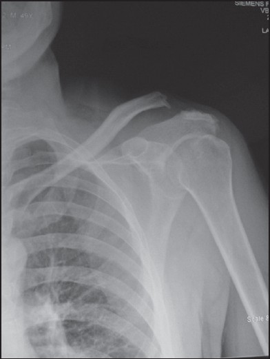 Figure 1: Anterior-posterior radiograph of the left shoulder of a 36-year-old male patient showing the failed reconstruction of the acromioclavicular (AC) joint with an allograft because of type 5 AC separation