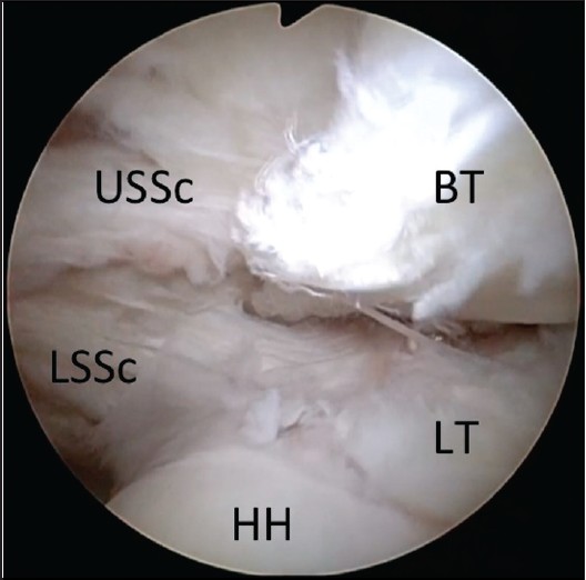 Figure 1: Arthroscopic view of a right shoulder through a posterior glenohumeral portal demonstrating an upper  subscapularis tear with subluxation of the biceps between the proximal, superficial upper subscapularis and the distal, deep lower subscapularis (BT, biceps tendon; HH, humeral head; LT, lesser tuberosity; USSc, upper subscapularis; LSSc, lower subscapularis)
