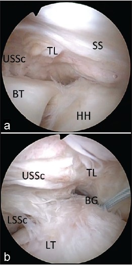 Figure 2: Arthroscopic view of a right shoulder through a posterior glenohumeral portal demonstrating an upper subscapularis tear with extension of the lateral border to the transverse ligament and supraspinatus tendon. The transverse ligament extends laterally draping over the long head of the biceps tendon and the bicipital groove. (a) Prior to biceps tenotomy. (b) Following biceps tenotomy. Sutures have been placed in the residual end of the long head of the biceps, which has been allowed to retract distally in the arm. (BG, bicipital groove; BT, biceps tendon; HH, humeral head; LT lesser tuberosity; USSc, upper subscapularis; LSSc, lower subscapularis; SS, supraspinatus; TL, transverse ligament)