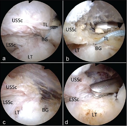 Figure 3: Arthroscopic view of a right shoulder through a posterior glenohumeral portal demonstrating the lateral release. (a) The lateral border of the upper subscapularis is defined by releasing the lateral extension of the transverse ligament. The release begins at the upper border of the subscapularis. (b) The release continues inferiorly separating the transverse ligament from the upper subscapularis and exposing the bicipital groove. (c) The completed release exposes the bicipital groove completely and the distal deep intact lower subscapularis. (d) With the lateral release completed, the entire upper
lesser tuberosity may now be accessed with ease for eventual repair. (BG, bicipital groove; LT, lesser tuberosity; USSc, upper subscapularis; LSSc, lower subscapularis; TL, transverse ligament)