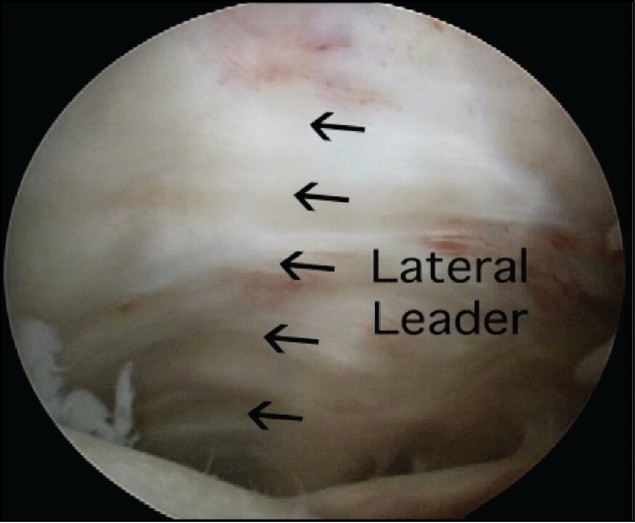 Figure 4: Arthroscopic view of a left shoulder through a posterior glenohumeral portal demonstrating a tear of the subscapularis tendon with the lateral border scarred to the inner deltoid fascia (i.e. lateral leader)