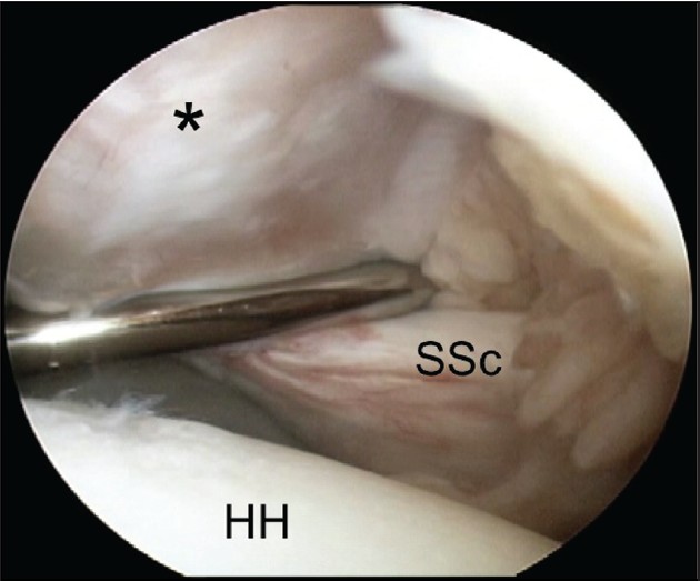 Figure 5: Arthroscopic view of a left shoulder through a posterior glenohumeral portal demonstrating traction on the comma sign (*) defining the superior and lateral borders of the subscapularis tendon (SSc). (HH, humeral head)