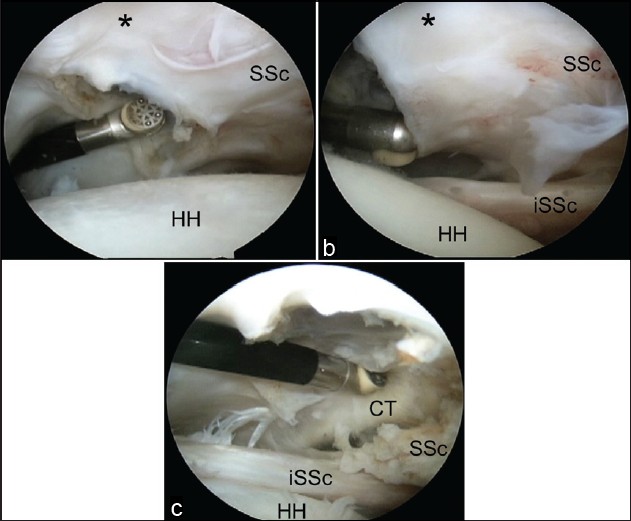 Figure 6: Arthroscopic view of a left shoulder through a posterior glenohumeral portal. (a) The initial release is started adjacent to the upper border of the subscapularis tendon (SSc) and the comma sign (*). (b) The release is continued inferiorly separating the subscapularis from the inner deltoid fascia and the conjoint tendon. (c) (CT, conjoint tendon; G, glenoid; HH, humeral head; iSSc, intact lower subscapularis)