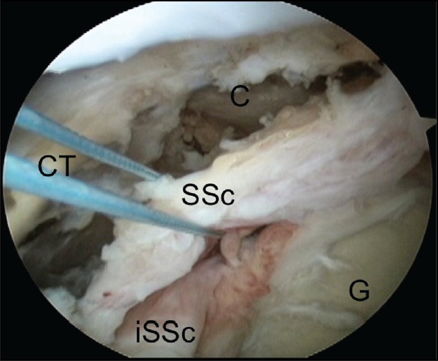 Figure 7: Arthroscopic view of a left shoulder through an anterosuperolateral portal demonstrating completed release of the
lateral border of the subscapularis allowing access to the subcoracoid space. (C, coracoid; G, glenoid; SSc, torn subscapularis; iSSc, intact lower subscapularis)