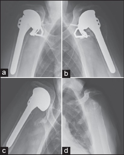 Figure 1: Anteroposterior radiograph of the patient in case one with the right (a) and left (b) shoulder showing the failed bilateral metalbacked glenoids. The right shoulder was revised to a large head hemiarthroplasty (c) and the left shoulder was revised with resection arthroplasty (1d)