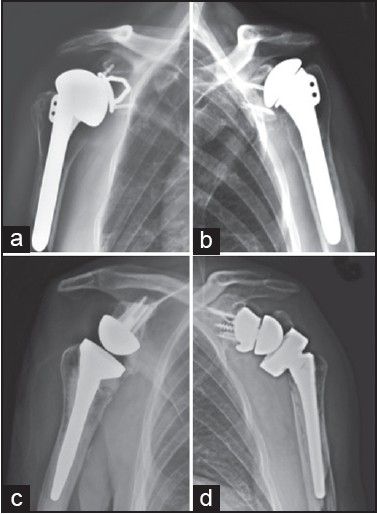 Figure 2: Anteroposterior radiograph of patient in case two with the right (a) and left (b) shoulder showing the failed bilateral metal-backed glenoids. The right shoulder was revised to a reverse arthroplasty (c) and the left shoulder was revised with a custom reverse arthroplasty after staged glenoid bone grafting with iliac crest autograft (d)