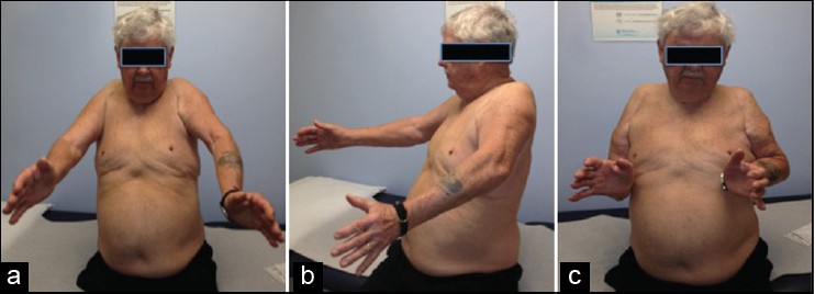 Figure 3: Clinical photograph of the patient in case one demonstrating limited range of motion in forward flexion (a and b) and external rotation (c). On the right shoulder, patient had a revision to a large head hemiarthroplasty and on the left shoulder; patient had a resection arthroplasty