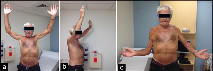 Figure 4: Clinical photograph of the patient in case two demonstrating excellent range of motion in forward flexion (a and b) and external rotation (c). On the right shoulder, patient had a revision to a reverse arthroplasty and on the left shoulder; patient had a staged glenoid bone graft and subsequent revision to a custom reverse prosthesis