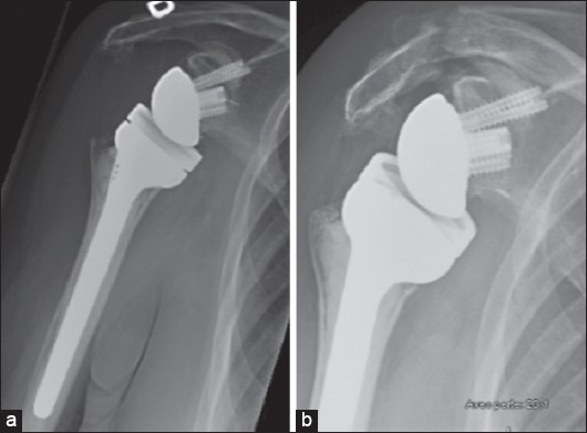 Figure 1: Antero-posterior radiographs showing the patient's right shoulder immediately after reverse shoulder arthroplasty (a) and after fracture, 5 months later (b). The post-operative image shows no preexisting acromial pathology