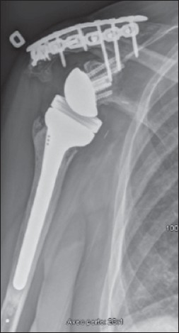 Figure 2: Antero-posterior radiograph of the right shoulder demonstrating the dual plating technique. This radiograph was taken at final follow-up (18 months)