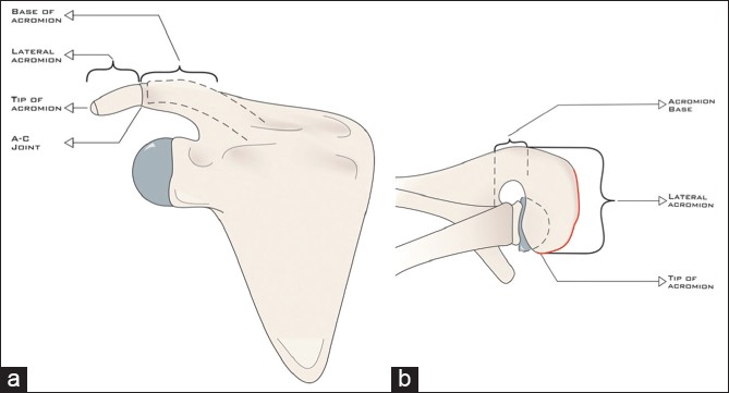 Figure 3: Coronal (a) and axial (b) representations of the proposed classification scheme for acromial fractures associated with revere arthroplasty