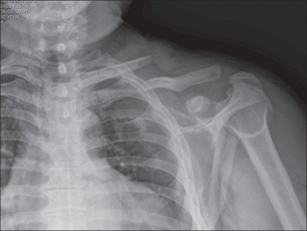 Figure 1: AP view of the left shoulder
