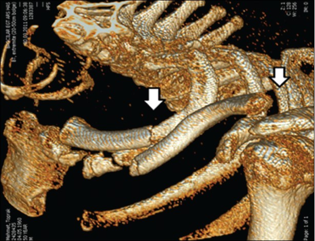 Figure 2: Three-dimensional computed tomography image of the left shoulder