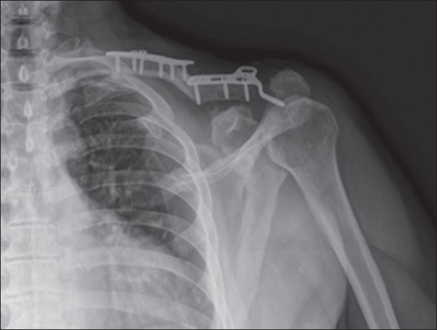 Figure 3: AP view of the left shoulder 23 months after surgery