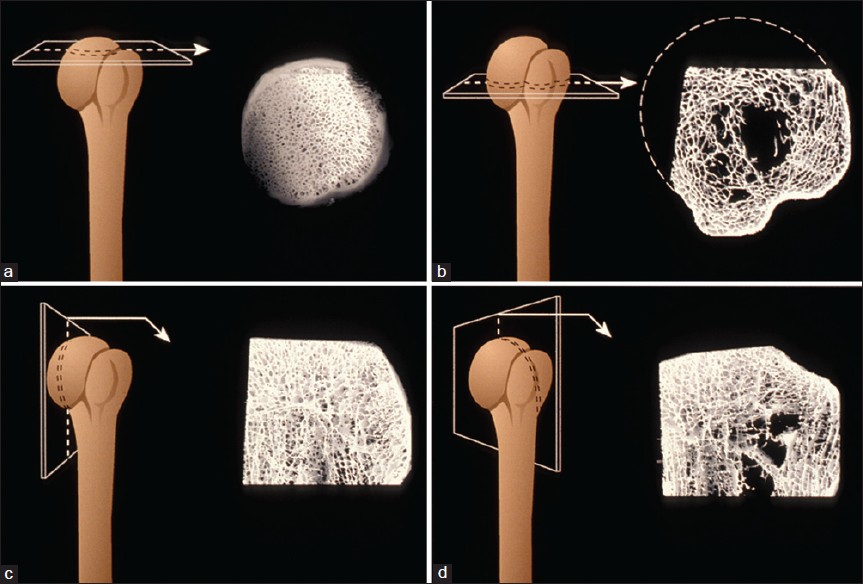 Figure 1: Graphical reconstructions of the humeral head. (a) The dense tubular arranged trabeculae formed the subchondral bone texture at the top of the head. Note the few connecting trabeculae. (b) The shift from plate-like trabeculae forming the greater tuberosity toward the center of the head is abrupt. (c) The wave-like remnants of the epiphyseal scar separates the subchondral bone from the trabeculae at the center of the head. (d) This section demonstrates the complex trabecular bone texture underneath the 