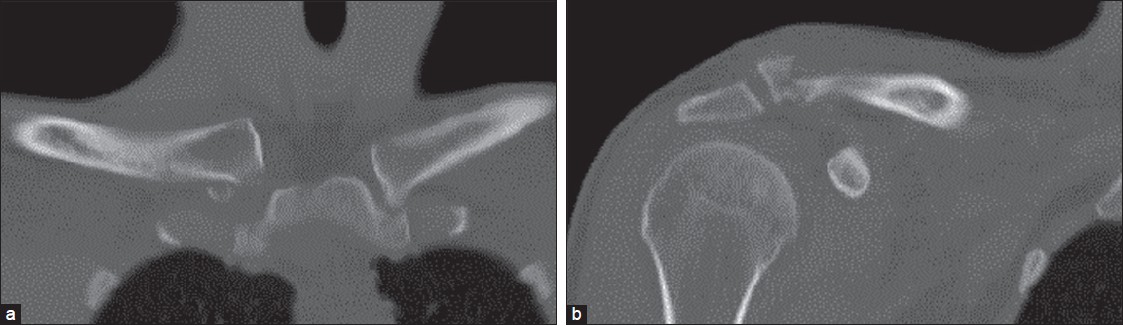 Figure 1: Preoperative CT scan shows a fracture dislocation of the SC Joint (a) and a lateral clavicle fracture (b)