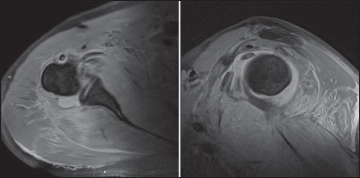 Figure 1: Axial and sagittal fat suppressed T2 weighted MR images displaying joint effusion and high signal change within the muscle bellies of subscapularis and teres minor